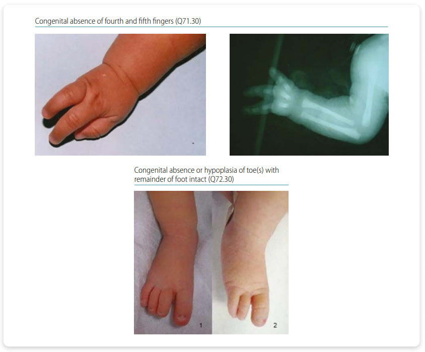 Congenital Anomalies and Deformations of the Musculoskeletal System | CDC