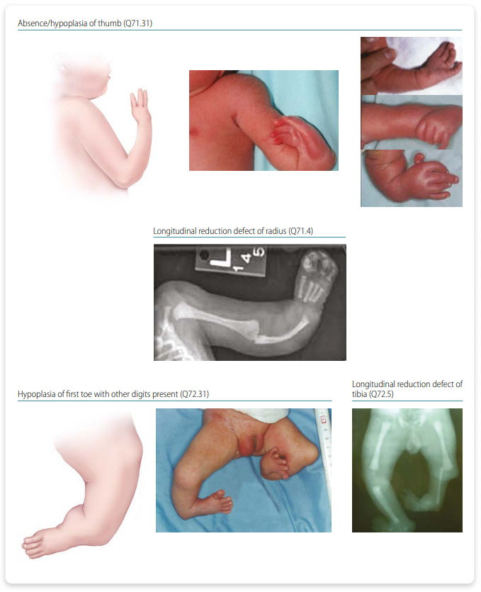 Longitudinal Preaxial