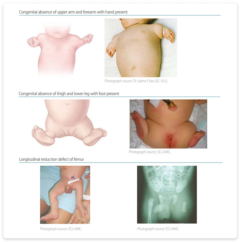 Transverse intercalary