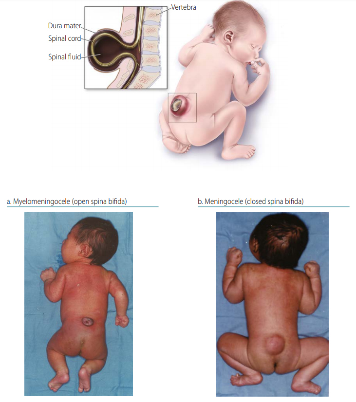 Spina bifida