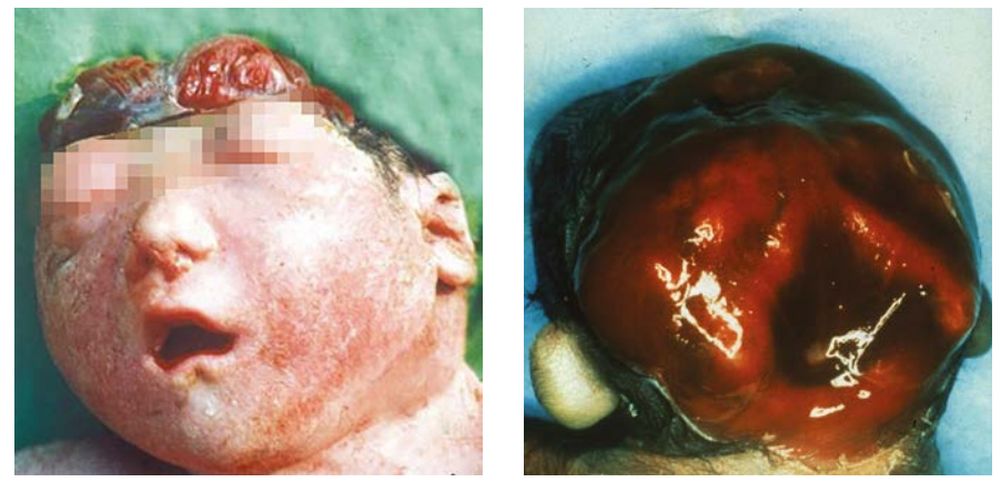 Holoanencephaly (total)