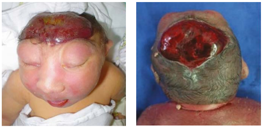 Meroanencephaly (partial)