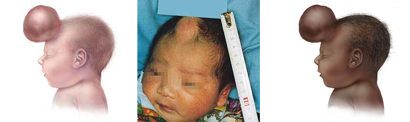 Graphic of frontal encephalocele