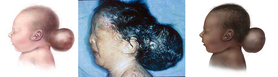 Graphic of baby with Encephalocele occipital