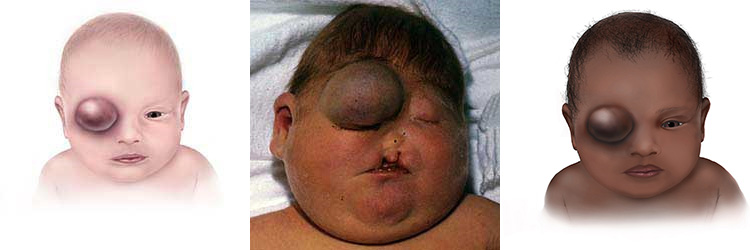 Graphic of baby with orbital encephalocele