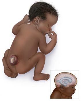 Graphic of baby with sacral spina bifida hydrocephalus