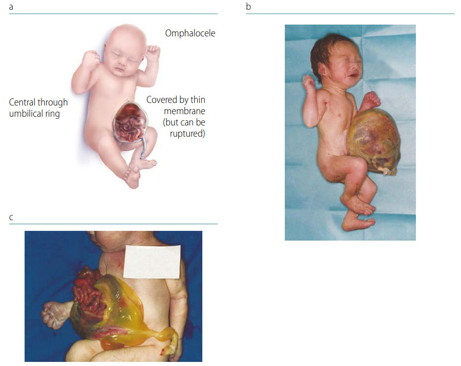 Fig. 48. Omphalocele