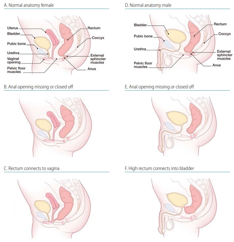 Fig. 31. Anorectal atresia/stenosis