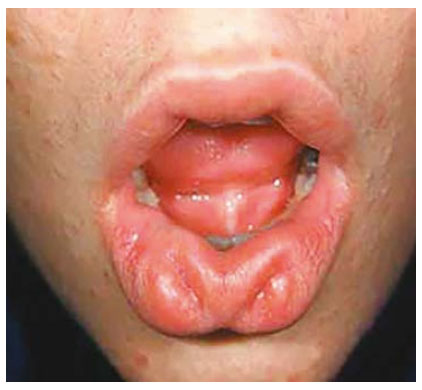 Fig. 23. Lip pits