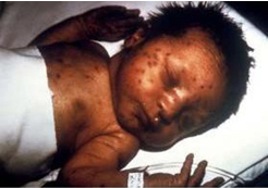 Congenital Infectious Syndromes: Congenital Rubella Syndrome | NCBDDD | CDC