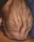 Posterior scalp view showing redundant scalp with folds (rugae).