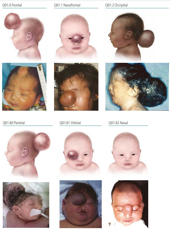 Fig. 5. Encephalocele