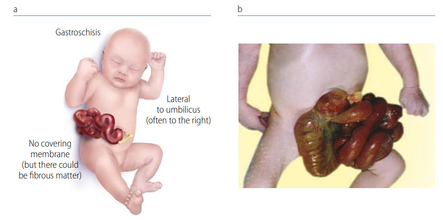 Fig. 50. Gastroschisis