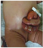 Gastroschisis