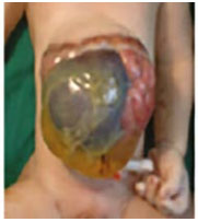 Omphalocele