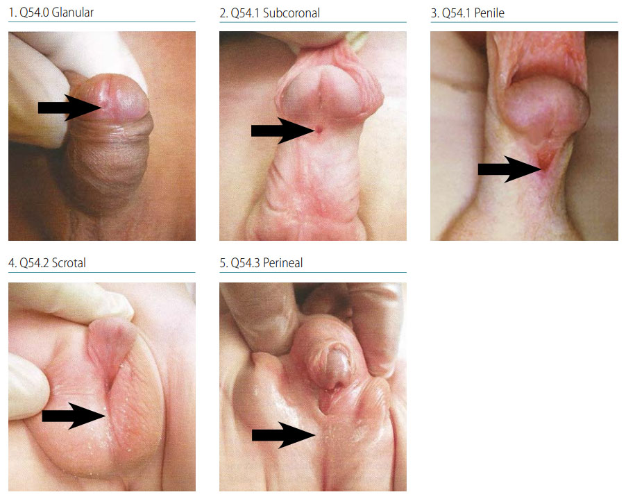 Fig. 32. Hypospadias