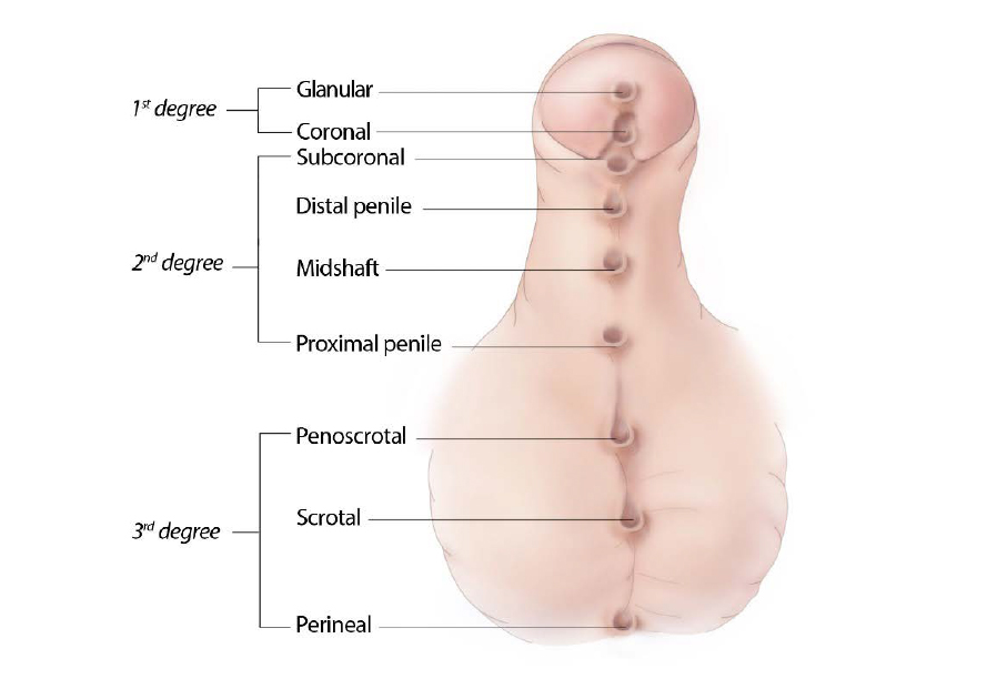 Illustration indicates all possible locations for the malformation, but typically a case will only have an opening in one location.