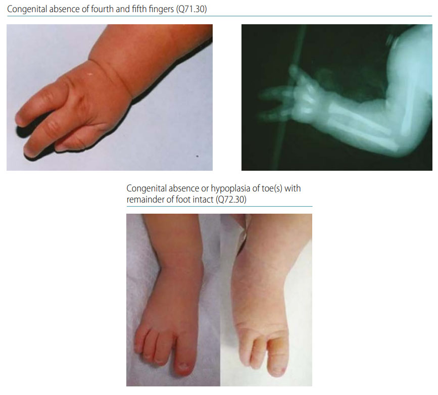 Fig. 46. Longitudinal postaxial