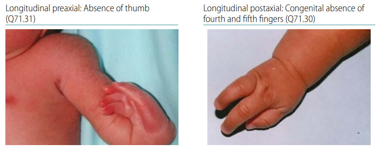 Longitudinal Postaxial (Fibula, Ulna, Fifth Ray) | NCBDDD | CDC