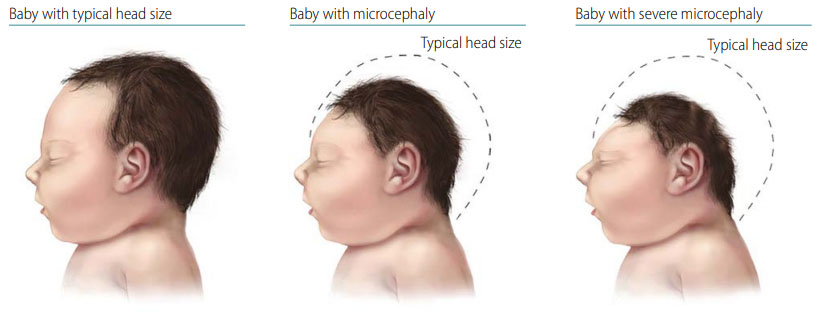 Fig. 11. Newborn with a normal head size, microcephaly, and severe microcephaly