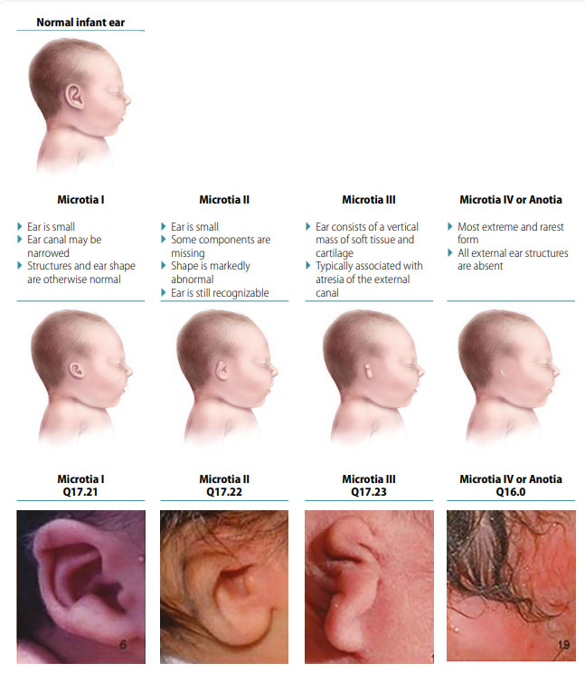 Fig. 13. Microtia/Anotia