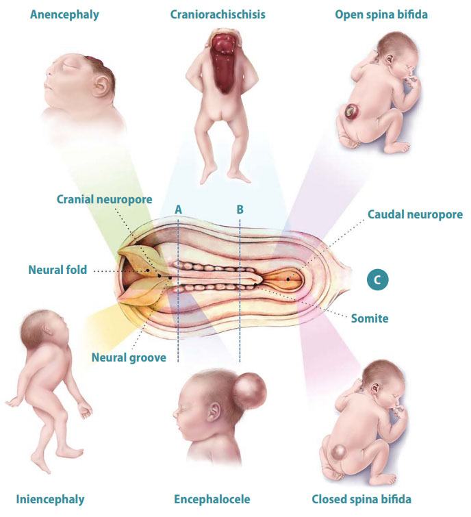 Neural tube defects