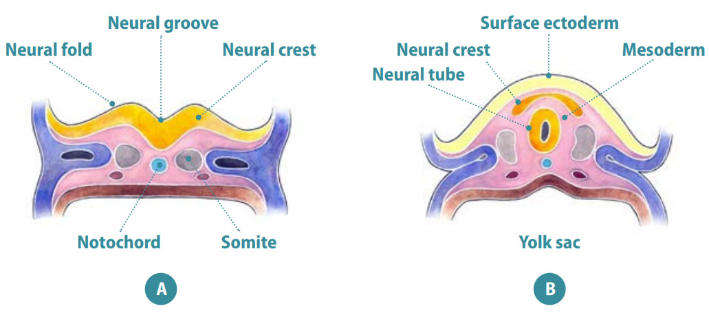 Neural Tube Defects