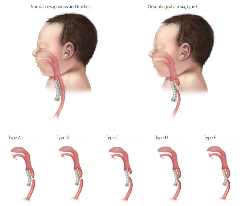 Fig. 29. Oesophageal atresia/tracheo-oesophageal fistula