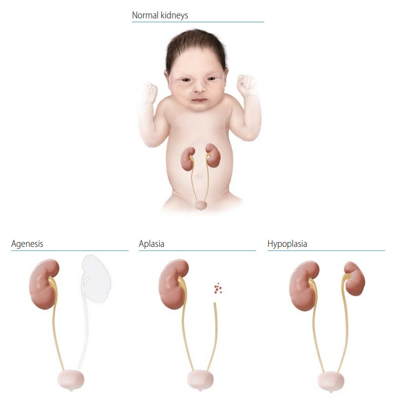 Fig. 33. Renal agenesis/hypoplasia