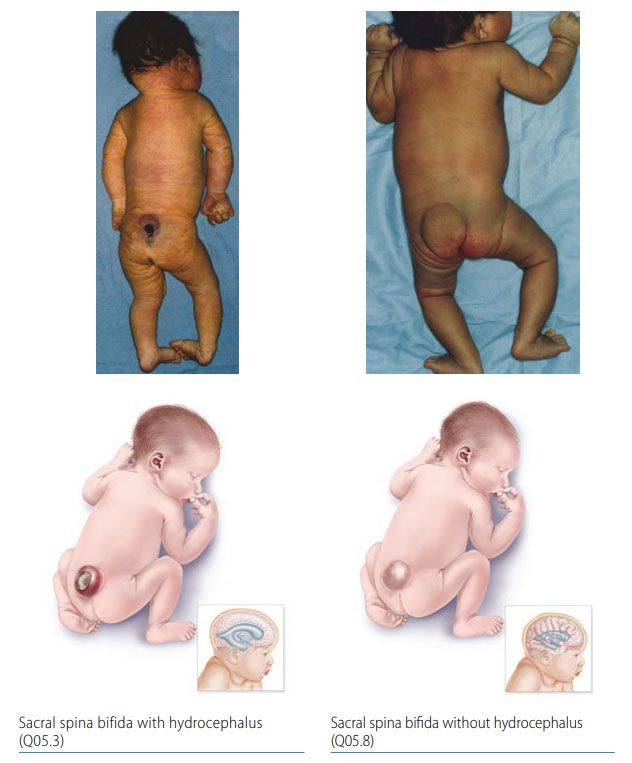 Fig. 10. Sacral spina bifida