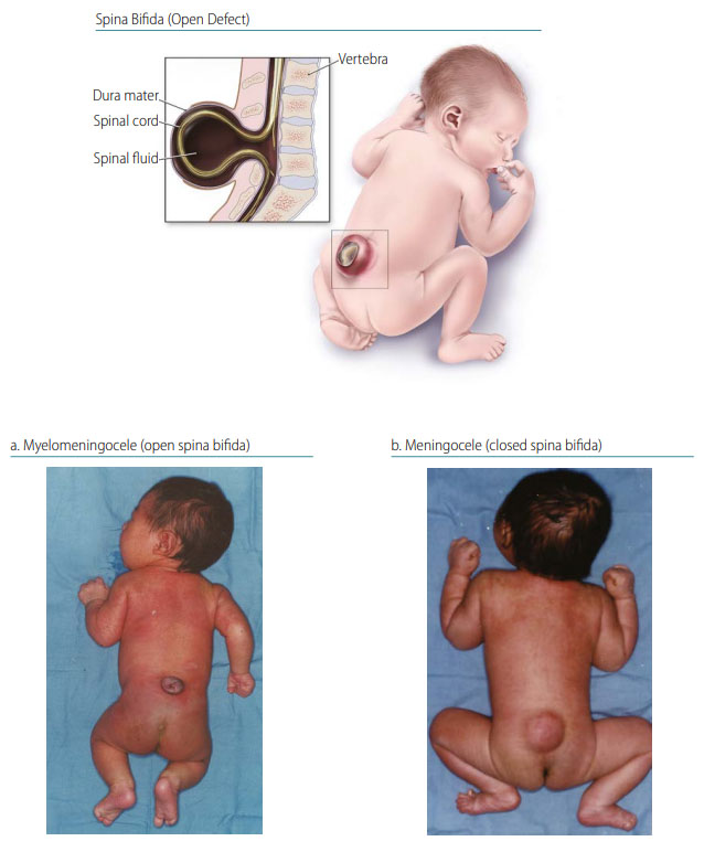 Fig. 6. Spina bifida