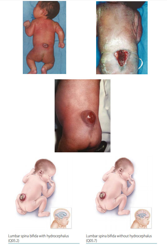 Fig. 9. Lumbar spina bifida