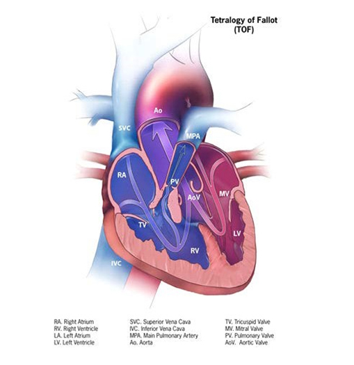 Tetralogy of Fallot