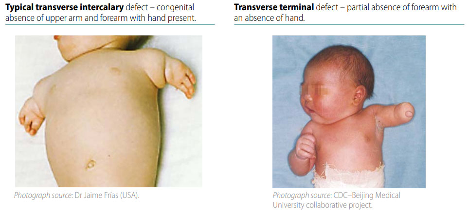 Fig. 41. Distinguishing intercalary defects from transverse terminal defects (side-by-side comparison)