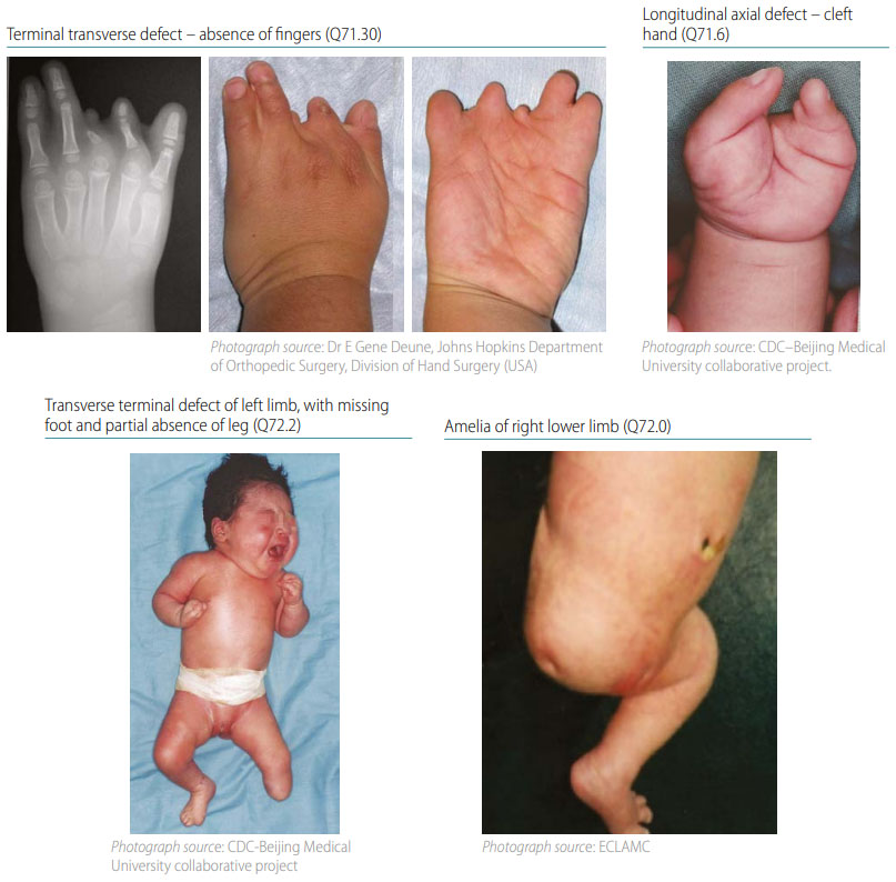 Fig. 39. Distinguishing transverse terminal defects from longitudinal axial defects and amelia (side-by-side comparison)