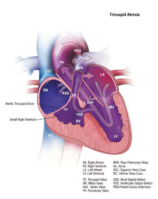 Fig. 18. Tricuspid valve atresia