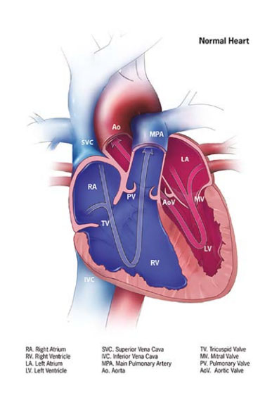 Fig. 18. Tricuspid valve atresia