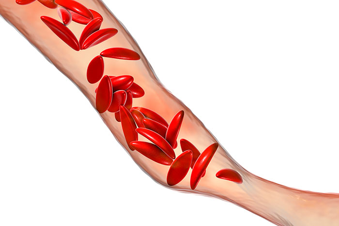 Sickle cell anemia, 3D illustration. Clumps of sickle cell block the blood vessel