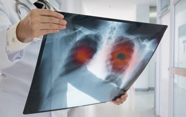 Chest x-ray film