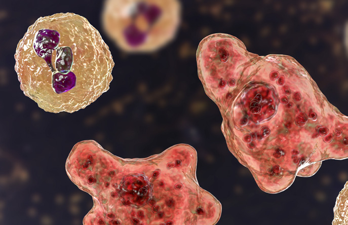 Cerebrospinal fluid smear containing brain-eating amoeba Naegleria fowleri and neutrophils