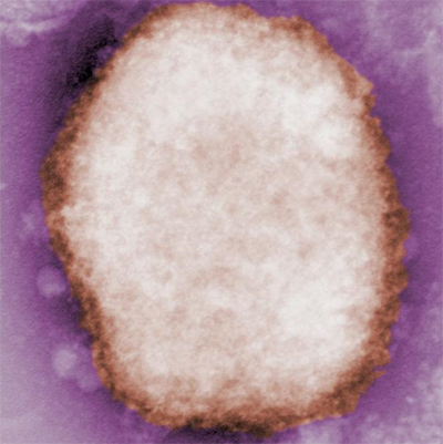 monkeypox virus virion in human vesicular fluid