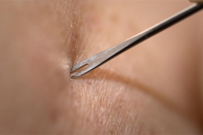 bifurcated needle pressed against human skin but not puncturing yet