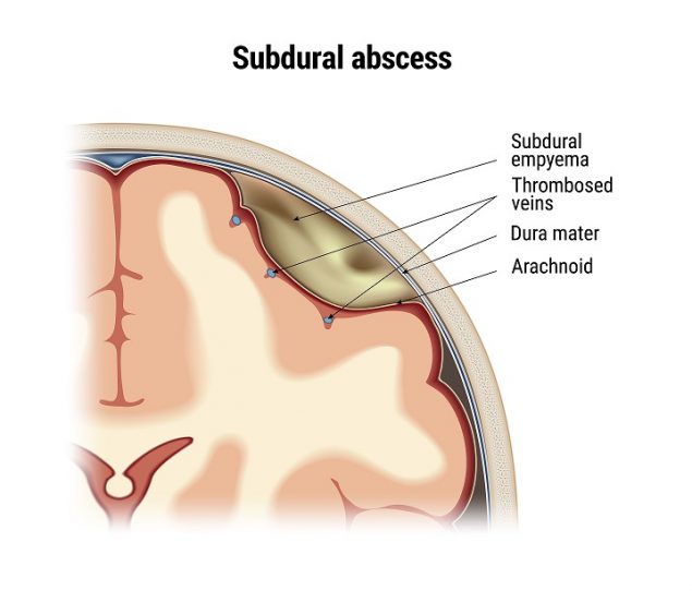 Illustration of subdural abscess