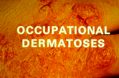 Occupational Dermatoses - Title Slide