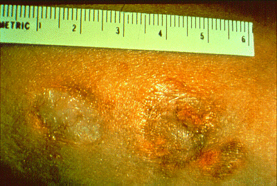 SLIDE 24 - Granuloma