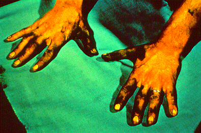 SLIDE 56 - Stained hands in foundry worker