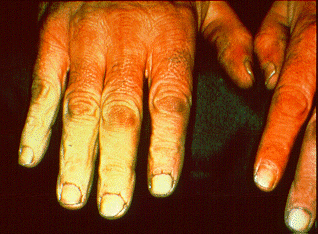 SLIDE 63 - Painful white fingers