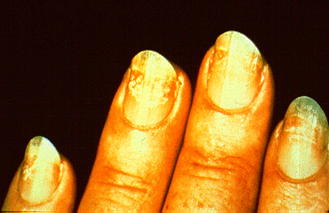 SLIDE 82 - Nail disorder, traumatic