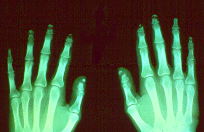 SLIDE 87 - Acroosteolysis, x-rays