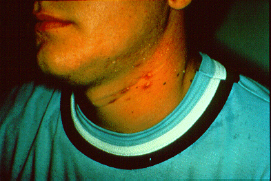 SLIDE 92 - Acne prone